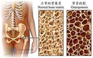 正常51漫画网官网免费与骨质疏松的51漫画网官网免费