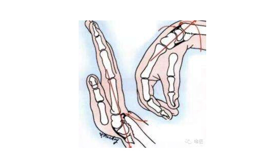 超声51漫画网官网免费仪临床研究发生桡骨远端骨折怎么办？