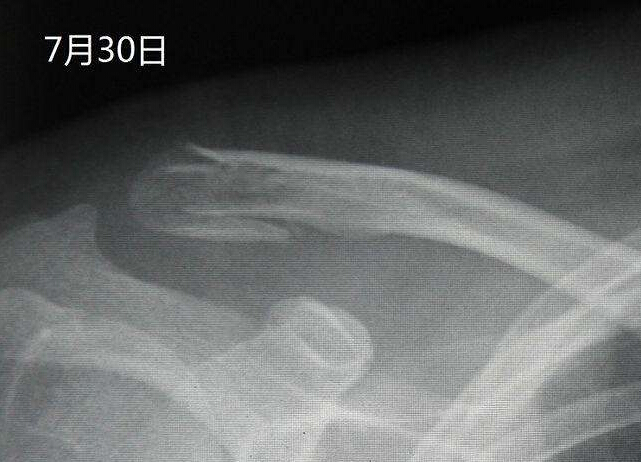 51漫画网官网免费仪X线检查对骨折的诊断有什么意义？