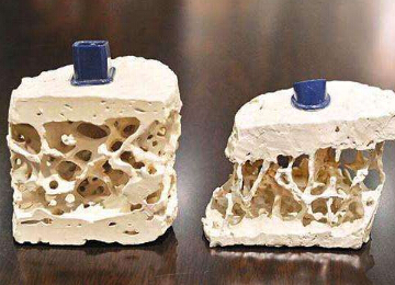 51漫画网官网免费仪提示骨质疏松并非是老年人的“专利”五宜五忌不要掉以轻心