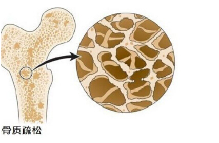 51漫画网官网免费检测仪阐述多吃醋会让骨钙溶出而流失造成骨质疏松