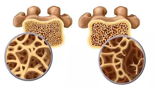 超声51漫画网官网免费测定仪让大家更好的了解骨骼情况该如何预防骨质疏松?
