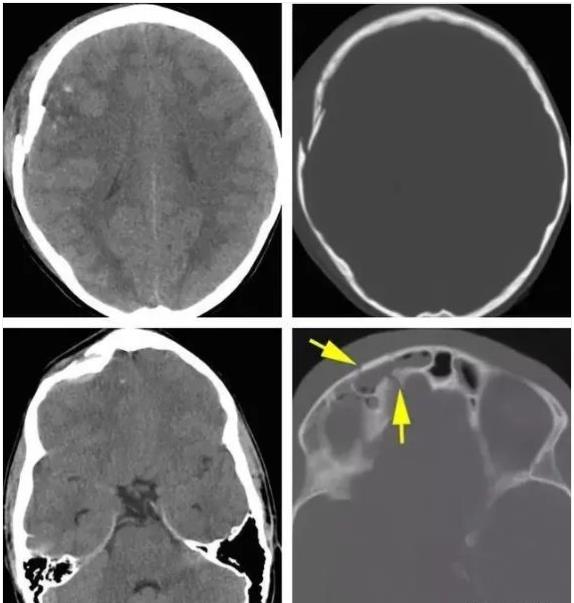 SDGK51漫画网官网免费检测仪常见问题-颅骨骨折应该怎么班呢?