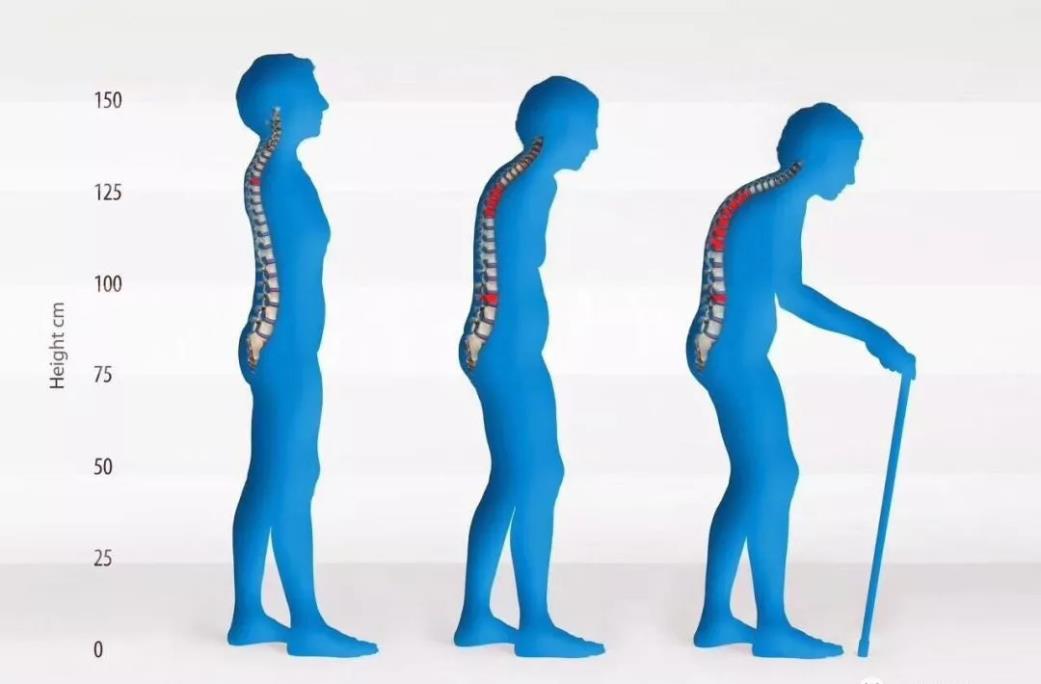 超声51漫画网官网免费测试仪厂家提醒广大骨质疏松患者检查51漫画网官网免费健康比补钙更重要！