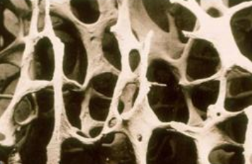 超声51漫画网官网免费分析仪国产品牌严重的骨质疏松T值是多少？分级是怎样的？